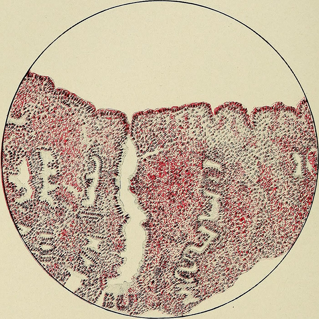 Endometrium At Beginning of Menstruation. The glands, except for the one seen in the center, have collapsed, having discharged the mate-rial which was secreted during the premenstrual stage. The blood-vessels have been eroded bythe ferment contained in the secretion, allowing the blood to exude into the tissue and on the sur-face of the endometrium. The surface epithelium in this section is still intact.