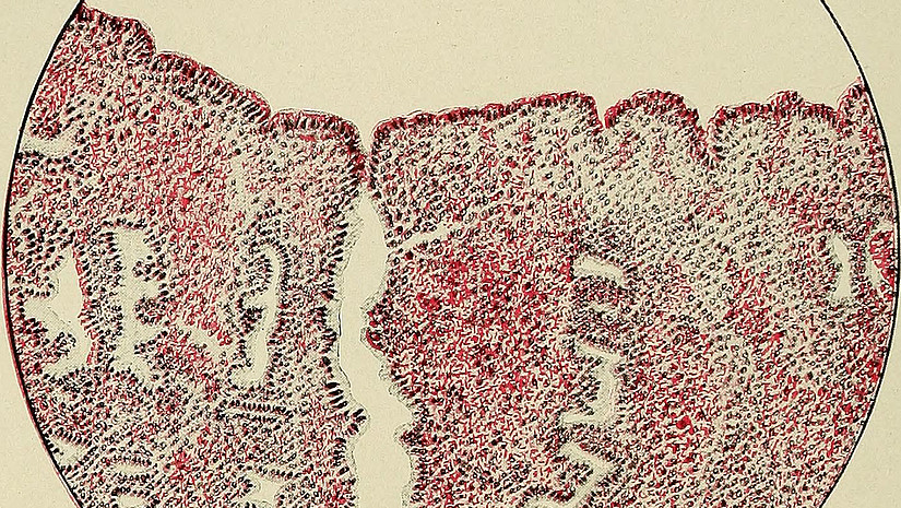 Endometrium At Beginning of Menstruation. The glands, except for the one seen in the center, have collapsed, having discharged the mate-rial which was secreted during the premenstrual stage. The blood-vessels have been eroded bythe ferment contained in the secretion, allowing the blood to exude into the tissue and on the sur-face of the endometrium. The surface epithelium in this section is still intact. 