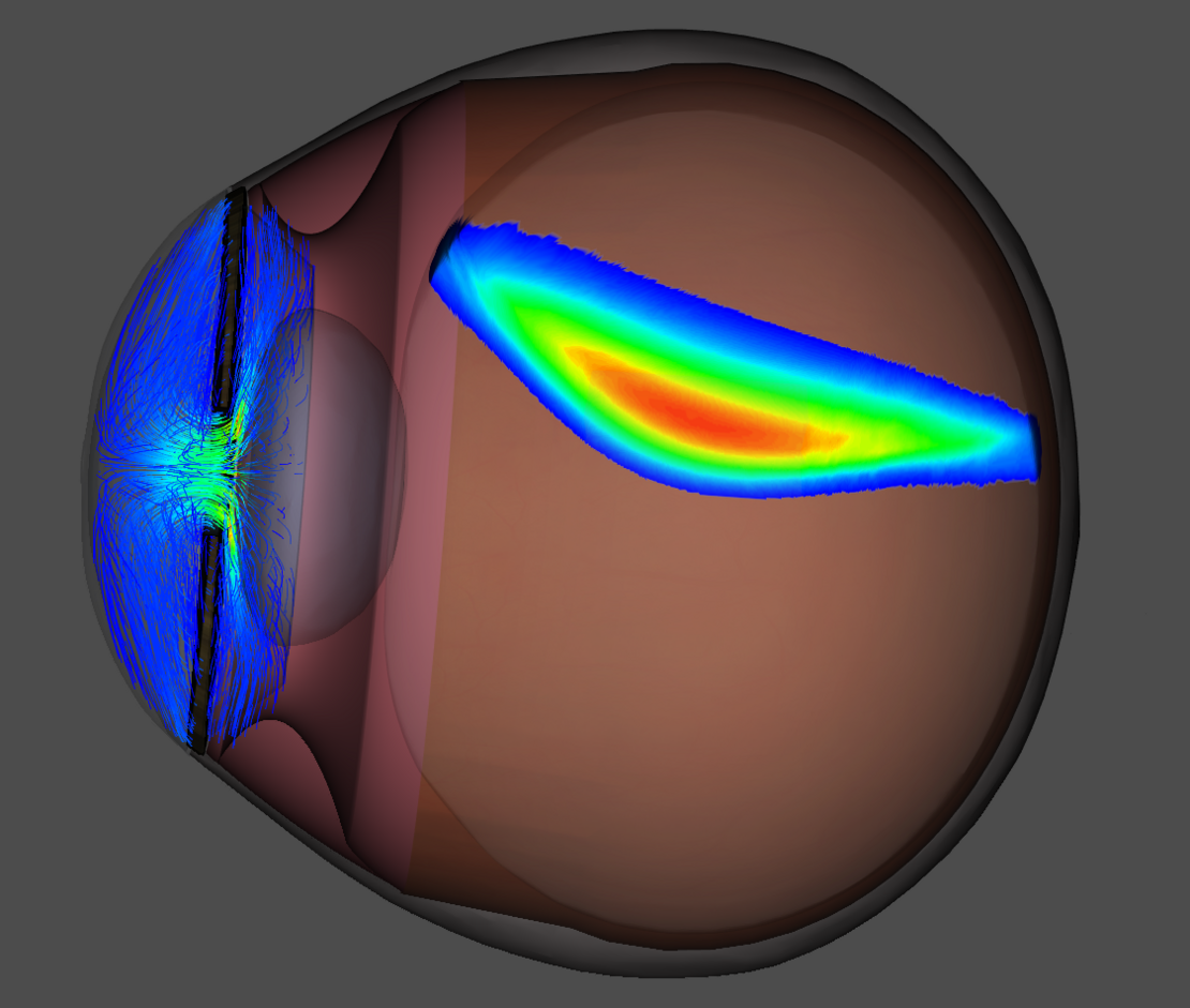 3D-Augengeometrie mit Darstellung der Kammerwasserströmung in Vorder- und Hinterkammer sowie der Medikamentenausbreitung im Glaskörper.